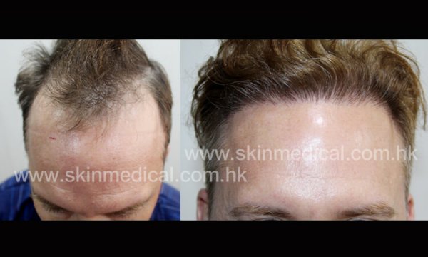 hairtransplantsecret5